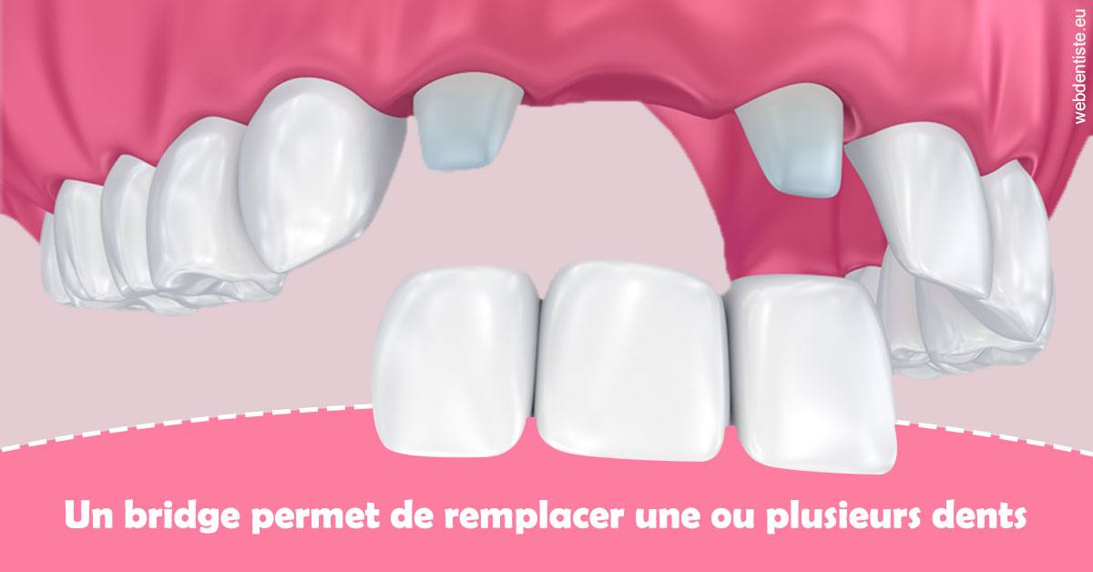 https://dr-bettinelli-dominique.chirurgiens-dentistes.fr/Bridge remplacer dents 2