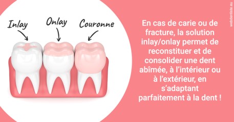 https://dr-bettinelli-dominique.chirurgiens-dentistes.fr/L'INLAY ou l'ONLAY 2