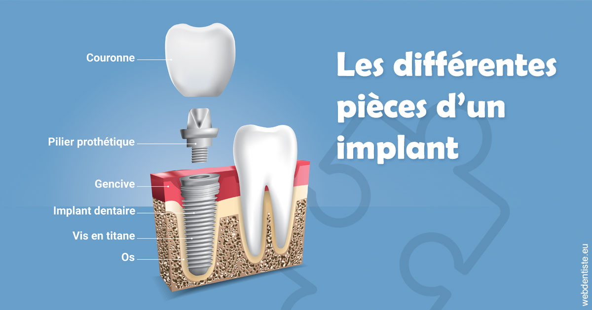 https://dr-bettinelli-dominique.chirurgiens-dentistes.fr/Les différentes pièces d’un implant 1